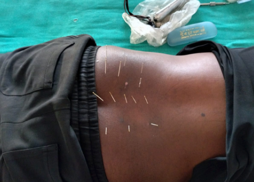 Acupuncture treatment