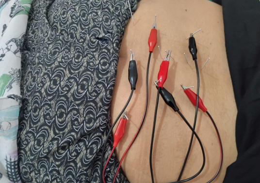 Electro-acupuncture